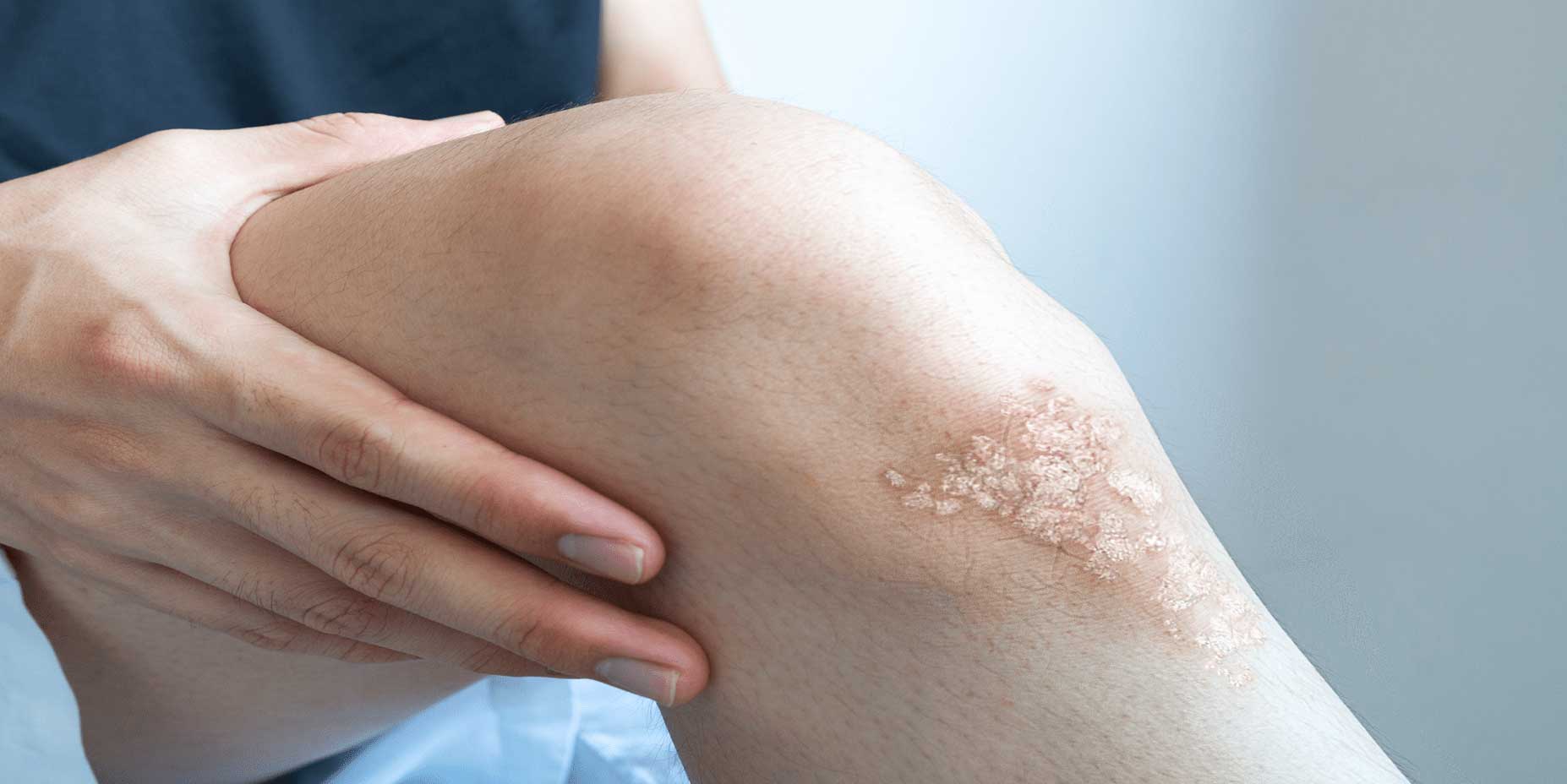 adult psoriasis before treatment PASI on knee