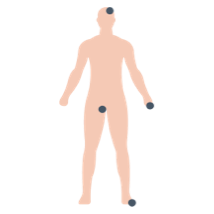 Body with points of psoriatic areas